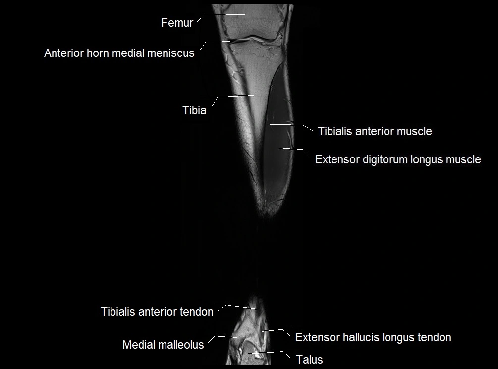 MRI 3T leg (tibia & fibula) labelled coronal cross sectional anatomy image 9.webp